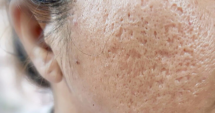 Sẹo rỗ – Hiểu đúng, trị chuẩn: Tránh “tiền mất tật mang” nhờ lời khuyên từ đội ngũ bác sĩ da liễu tại HKmedi- Ảnh 2.