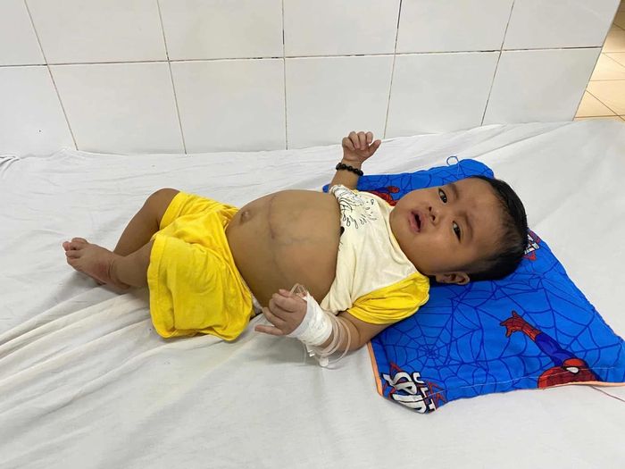 Ánh mắt cầu cứu của bé trai 7 tháng tuổi bụng to bất thường vì bệnh hiểm nghèo- Ảnh 4. Ánh mắt cầu cứu của bé trai 7 tháng tuổi bụng to bất thường vì bệnh hiểm nghèo- Ảnh 4.