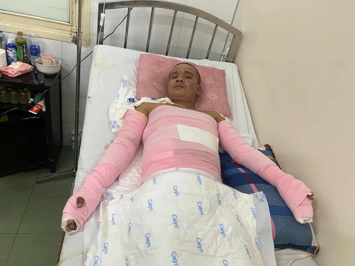 Xót xa hoàn cảnh người đàn ông bỏng nặng khi đi làm thuê kiếm tiền chạy chữa cho vợ - Ảnh 1.