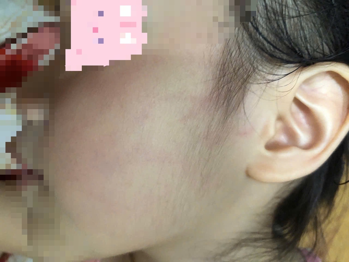 Bé gái 4 tuổi không dám đến trường sau khi bị cô giáo tát vào má, chấn thương - Ảnh 2.