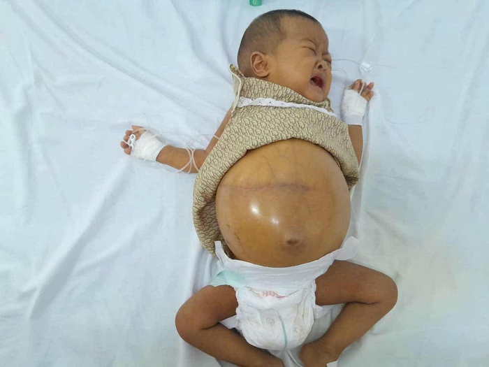 Ánh mắt cầu cứu của bé gái 6 tháng tuổi có bụng chực "nổ tung" - Ảnh 4.