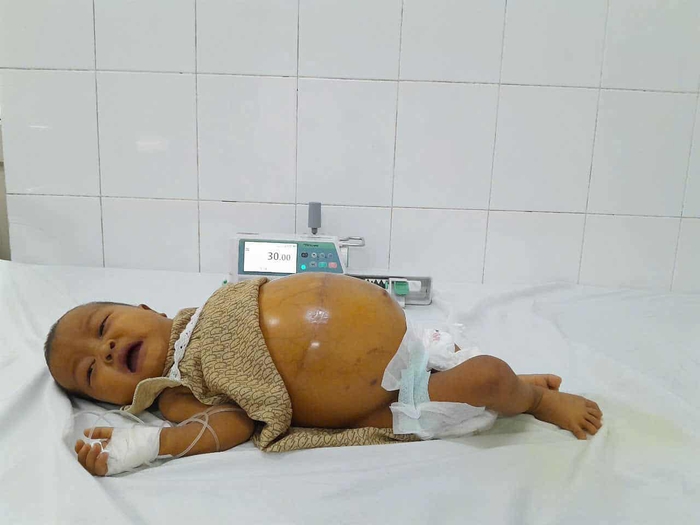 Ánh mắt cầu cứu của bé gái 6 tháng tuổi có bụng chực "nổ tung" - Ảnh 1.