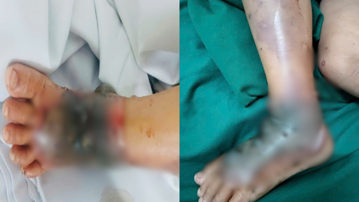 Bé trai 4 tuổi nguy kịch vì đắp thuốc nam chữa vết mèo cào- Ảnh 1. Bé trai 4 tuổi nguy kịch vì đắp thuốc nam chữa vết mèo cào- Ảnh 1.
