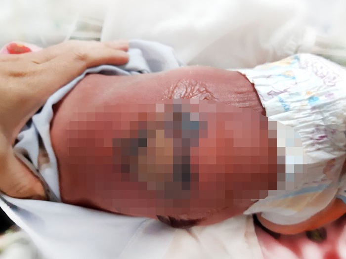 Bé sơ sinh bị bỏng nặng, nhiễm trùng máu khi nằm hơ than cùng mẹ - Ảnh 1.