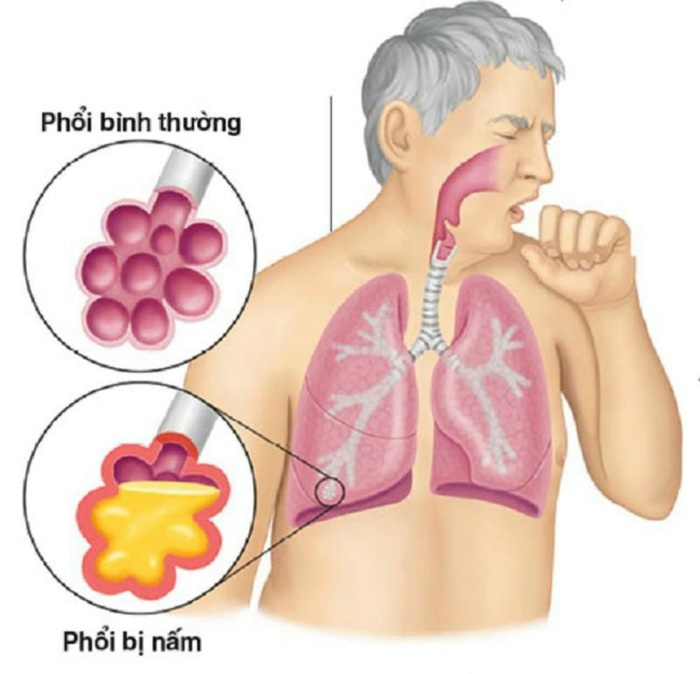 Gần 15.000 người Việt mắc bệnh phổi do nấm mỗi năm - Ảnh 3.