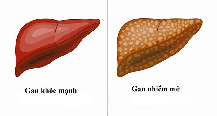 5 loại thực phẩm người mắc gan nhiễm mỡ độ 2 nhất định không nên ăn - Ảnh 1.