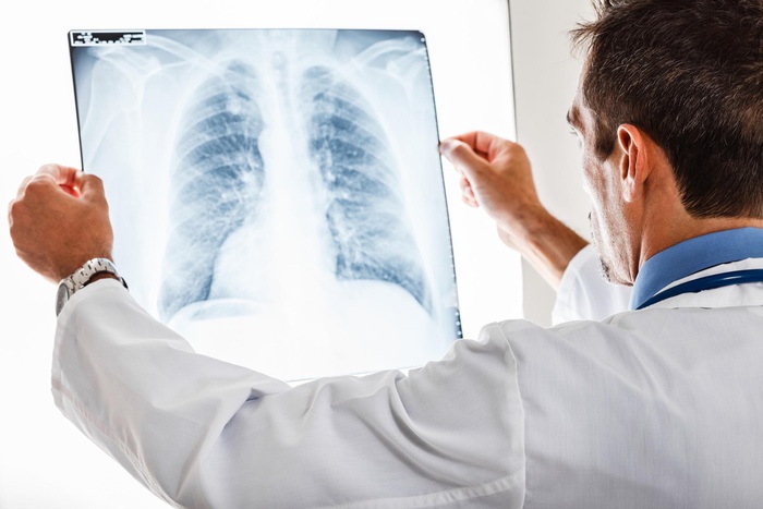 4 biến chứng nguy hiểm của viêm phổi covid - Ảnh 1.