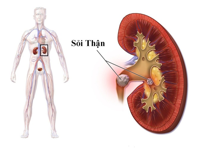 Triệu chứng, dấu hiệu mắc bệnh thận hay gặp - Ảnh 3.