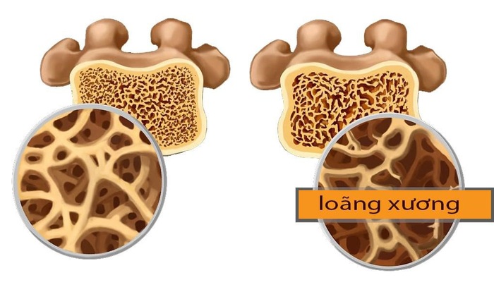 Dấu hiệu suy thận thường gặp ở nam giới và nữ giới - Ảnh 6.