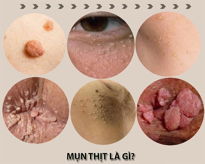 15 cách trị mụn thịt tận gốc quanh mắt và vùng cổ tại nhà an toàn hiệu quả nhất - Ảnh 1. 15 cách trị mụn thịt tận gốc quanh mắt và vùng cổ tại nhà an toàn hiệu quả nhất - Ảnh 1.