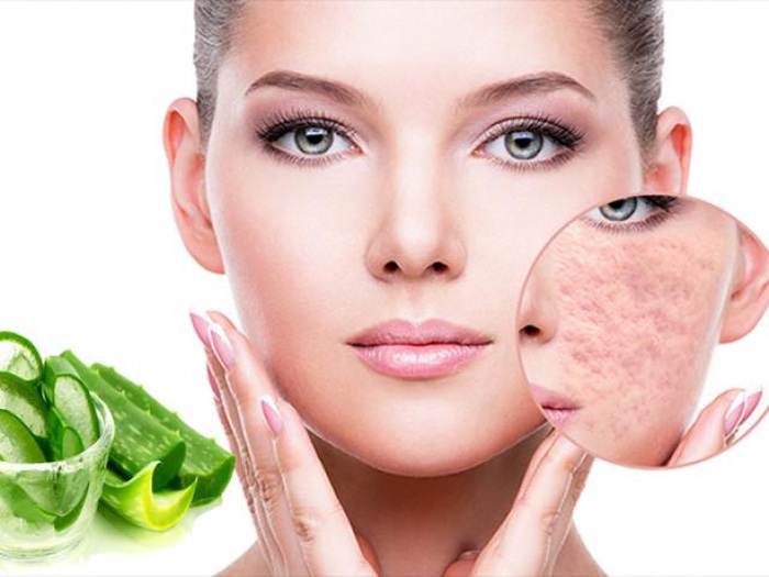 Cách trị sẹo rỗ lâu năm an toàn hiệu quả nhất từ nguyên liệu dễ kiếm » Báo Phụ Nữ Việt Nam