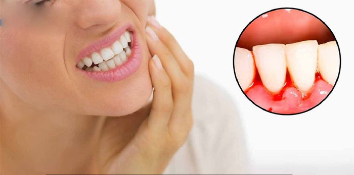Tẩy trắng răng có hại gì với sức khỏe và có đau không? - Ảnh 6.