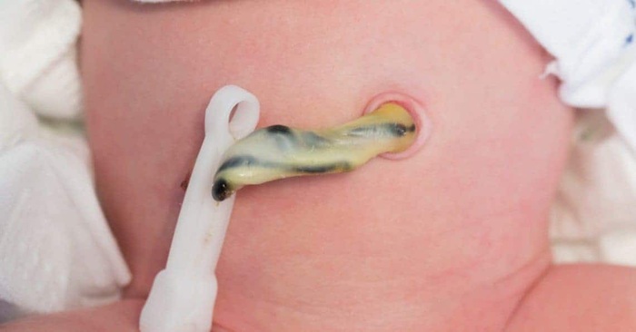 Hình ảnh rốn trẻ sơ sinh bị nhiễm trùng khiến nhiều mẹ sửng sốt  - Ảnh 4.