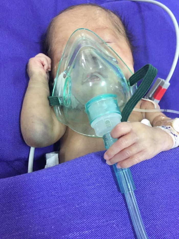 Sau sinh, bé thường xuyên phải thở máy