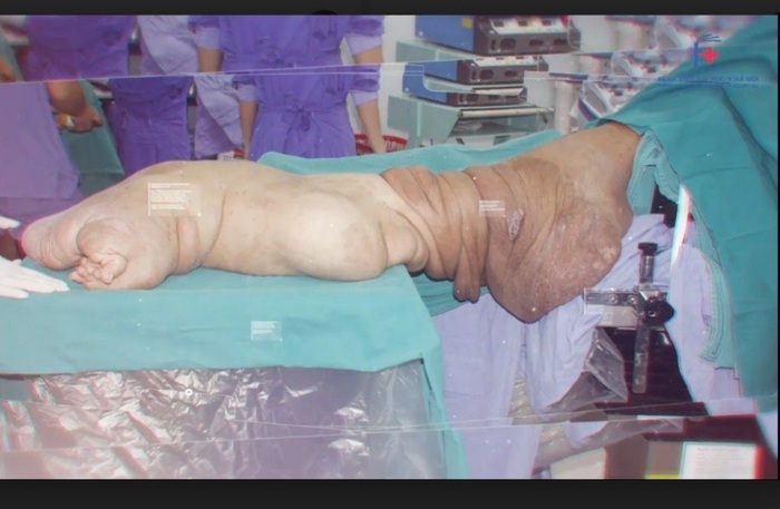 Chân trái của bệnh nhân trước khi phẫu thuật