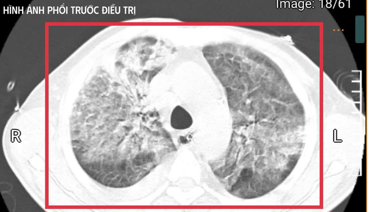 Bệnh nhân trở về từ Thái Lan nguy kịch do mang vi khuẩn cực nguy hiểm- Ảnh 1.