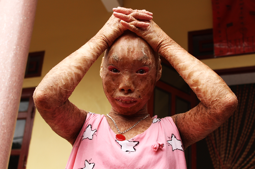 Xót thương 2 chị em mắc bệnh lạ, không dám đi học vì bạn gọi là "con ma"