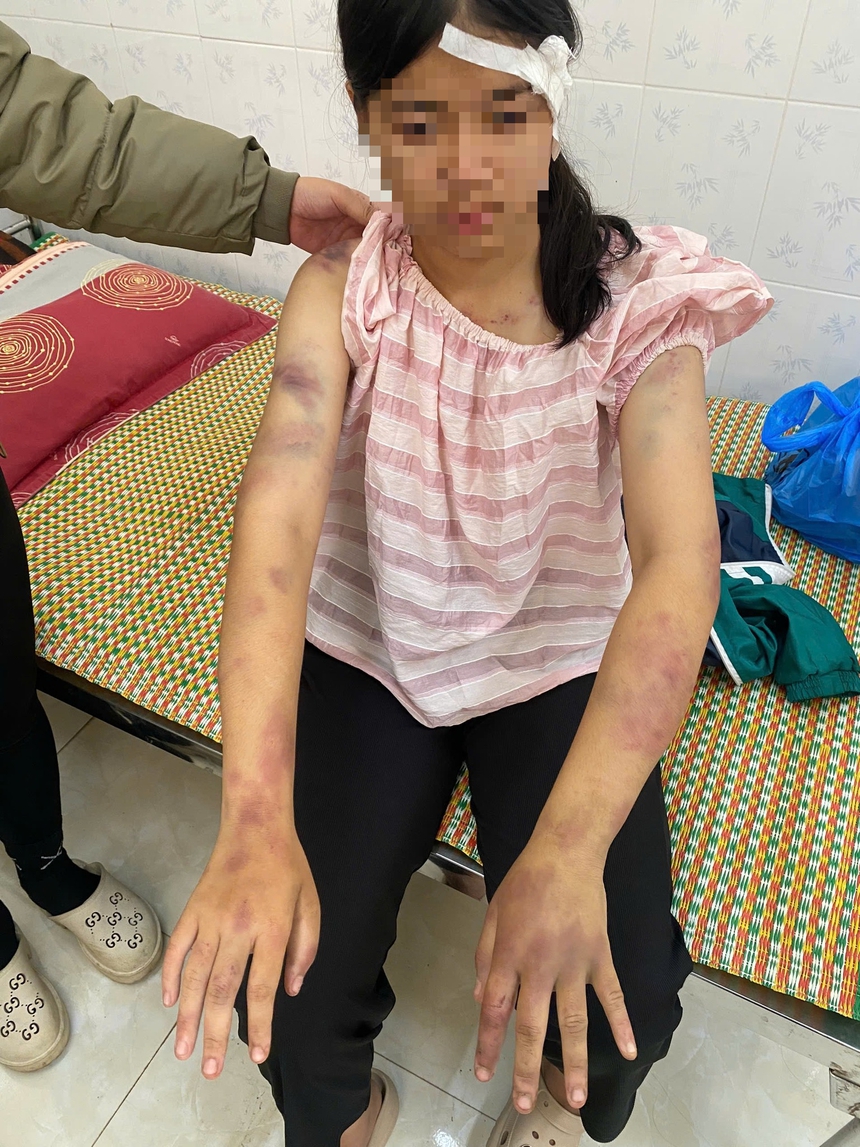 Vụ bé gái 13 tuổi bị bạo hành dã man ở Thái Nguyên: Vì sao tỷ lệ tổn thương cơ thể chỉ 5%?- Ảnh 2.