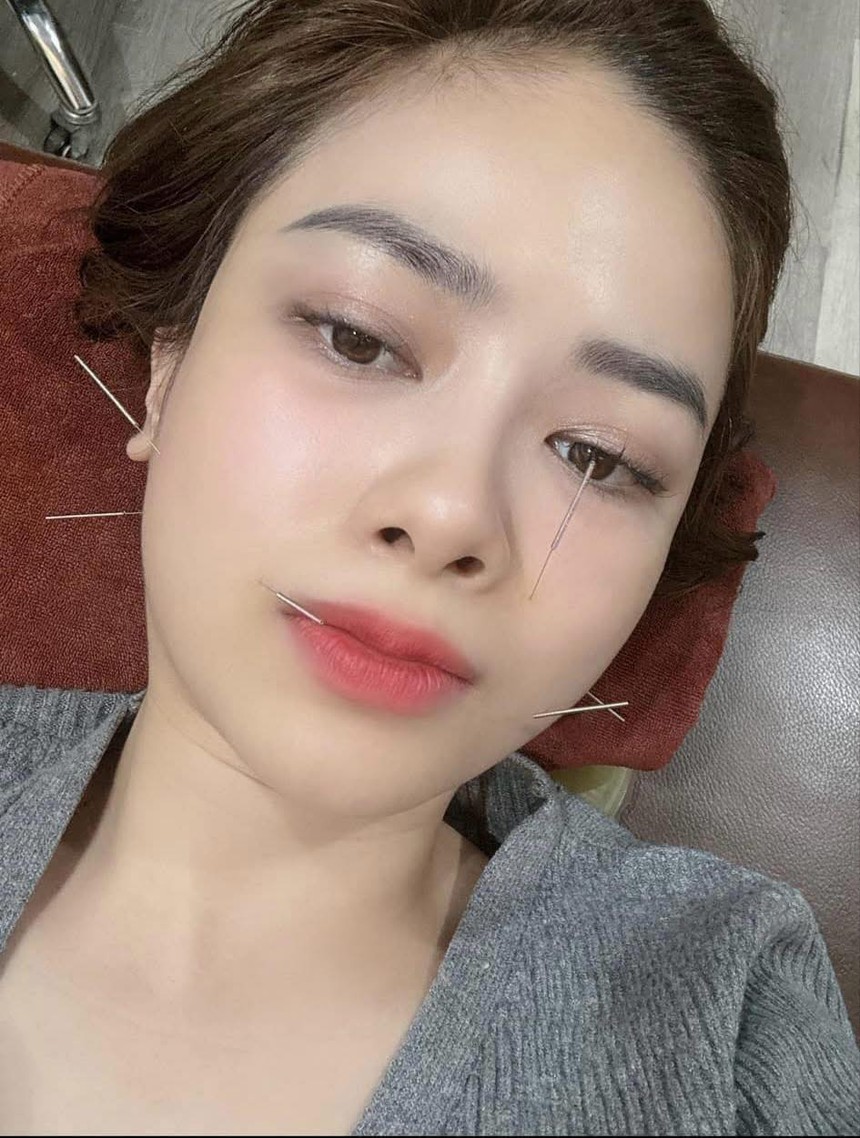 Chuyên gia cảnh báo về căn bệnh liệt dây thần kinh số 7- Ảnh 1.