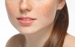 Mặt biến dạng do trị rám má tại spa, thẩm mỹ viện tư
