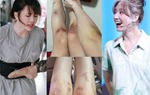 Sở hữu đôi chân ngọc ngà, Hari Won và Thiều Bảo Trâm lộ vết thương chi chít ai cũng xót