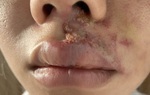 Mặt sưng phù, mưng mủ sau khi tiêm filler tại viện thẩm mỹ 