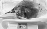 Khối u xơ nặng gần 4kg chiếm trọn thân tử cung
