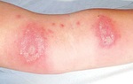 Cẩn thận với viêm da tiếp xúc do côn trùng mùa mưa bão