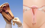 Bác sĩ phụ khoa giải đáp: Có bao nhiêu loại vòng tránh thai và những ai không nên tránh thai bằng cách này