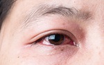 Gai người trước những hình ảnh triệu chứng của bệnh đau mắt đỏ