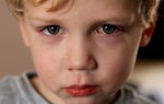 Đau mắt đỏ: Những biện pháp phòng tránh lây nhiễm từ người bệnh 