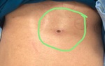 Người đàn ông bị suy đa tạng do bị sốt mò