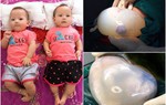 Mẹ Vĩnh Phúc sinh đôi, em bé thứ 2 chào đời cả e-kíp mổ hối nhau chụp ảnh