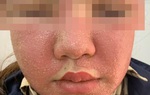 Mọc mụn mủ chi chít sau khi đắp mặt nạ làm trắng da mua trên mạng
