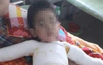 Bé trai 5 tuổi bỏng nặng do nghịch bật lửa