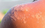 Bỏng nắng: Hướng dẫn xử trí và cách phục hồi