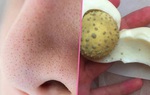 3 cách trị mụn đầu đen bằng trứng gà, lột đến đâu mụn tự khắc hết đến đấy