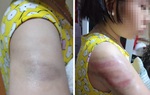 Nam Định: Xác minh thông tin học sinh lớp 4 bị cô giáo đánh tím người