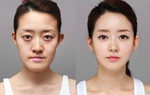 Những điều cần biết về phẫu thuật gọt hàm