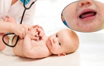 Trẻ mắc bệnh tay chân miệng khi nắng nóng và cách xử trí