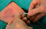 Cấy que tránh thai và những điều cần biết