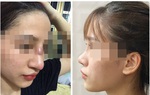Suýt hỏng mũi do nhiễm trùng sau khi nâng mũi tại spa