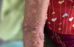 Bé gái 8 tuổi phải nhập viện điều trị do bị sứa biển cắn