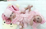 Mổ tách bé gái song sinh dính liền vùng bụng chậu cực kỳ hiếm gặp