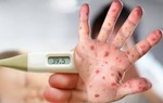 Bác sĩ nhi chỉ dấu hiệu trẻ mắc tay chân miệng nhiều bố mẹ thường chủ quan bỏ qua