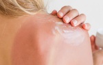 Cần làm gì khi bị mụn nước do cháy nắng?