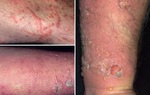 3 biến chứng khi bị kiến ba khoang đốt: bỏng, lở loét thậm chí là mù tạm thời