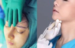 Băn khoăn giữa cấy mỡ tự thân và tiêm filler, nên chọn phương pháp nào làm đẹp gương mặt?