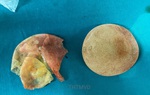 Nâng ngực ở thẩm mỹ viện tư, nữ bệnh nhân bị vỡ túi ngực mà không biết