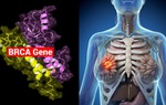 Nguy cơ ung thư vú do gene BRCA và cách hạn chế rủi ro